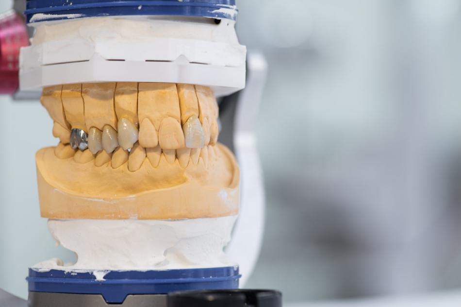 Устаревшие типу установки имплантов зубов.