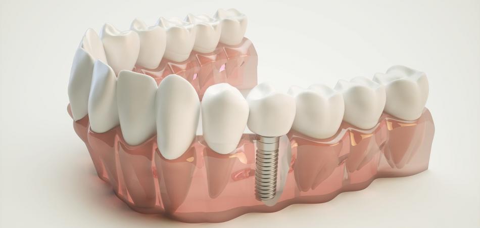 Какие есть виды имплантации зубов: список всех типов.