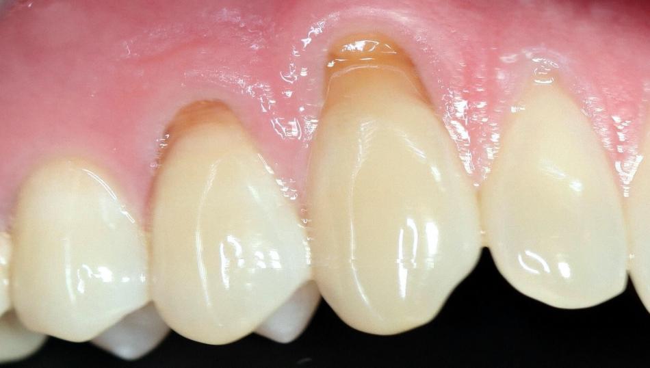 Зубной клиновидный дефект: лечение и профилактика.