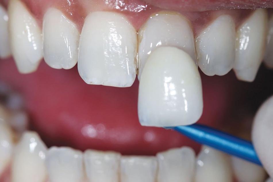 Как устанавливают компониры на зубы?