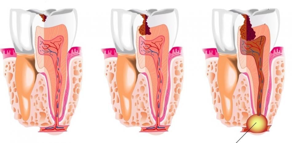 Гранулема корня зуба - причины и лечение.