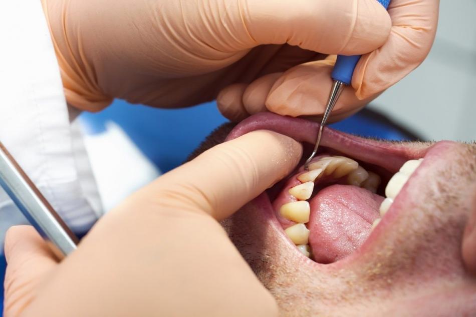 Цена лечения пародонтита в стоматологии.