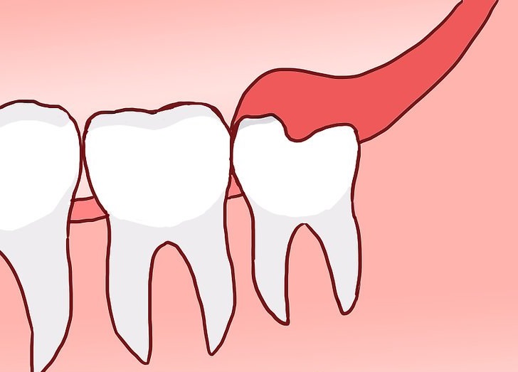 Когда требуется иссечение капюшона зуба?