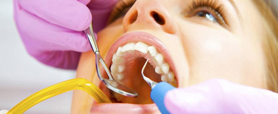 Сколько стоит удаление зубного камня ультразвуком?