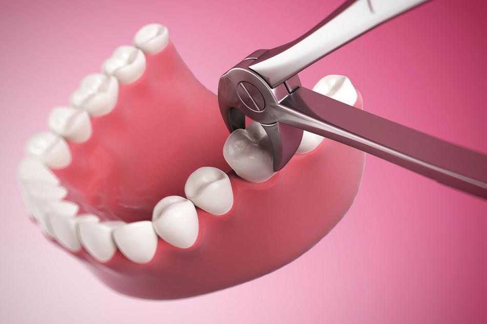 Как удаляют разрушенный зуб?