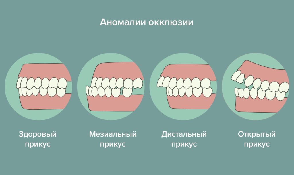 Как исправить неправильный прикус зубов?