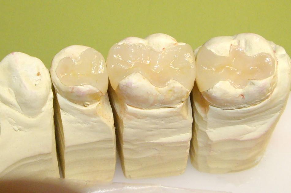 Керамическая пломба или вкладка как способ восстановления зуба.