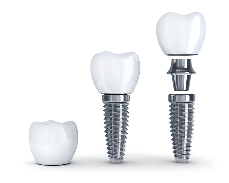 Импланты для зубов: производители и отзывы.